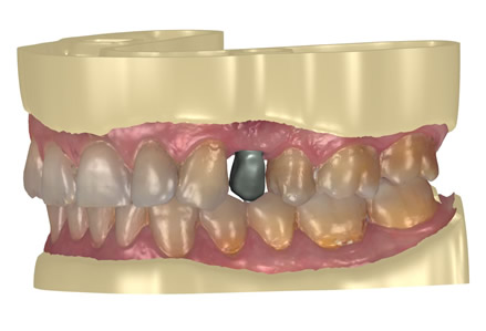 Implant