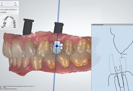 Implant